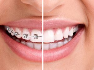 De cate tipuri sunt aparatele dentare?